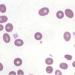 Figure 1: Full blood picture showing severe anaemia with ovalostomatocytes. (Wright’s stain x40)